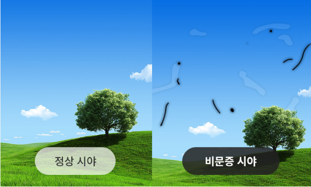 비문증 자가 진단법 – 원인, 증상, 관련 질병 체크